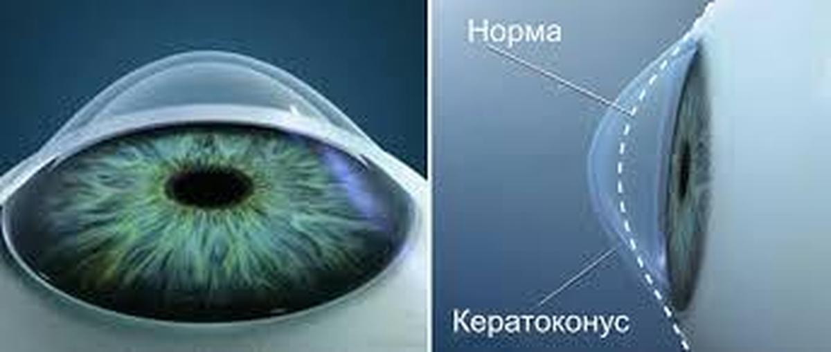 Стоимость очковых линз астигматизм