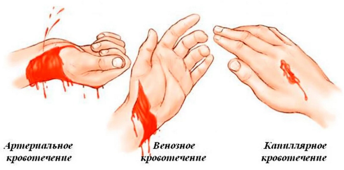 Вены на носу как избавиться